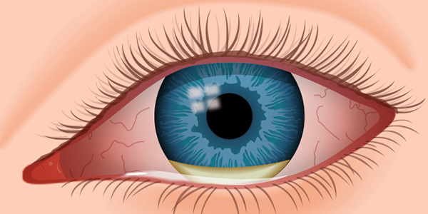 Post operative lasik care